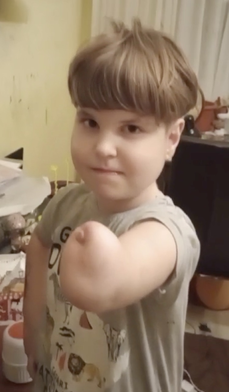 A. showing his left residual limb, before receiving the arm