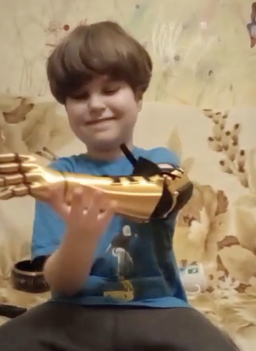A. holding and examining his new arm, delivery day