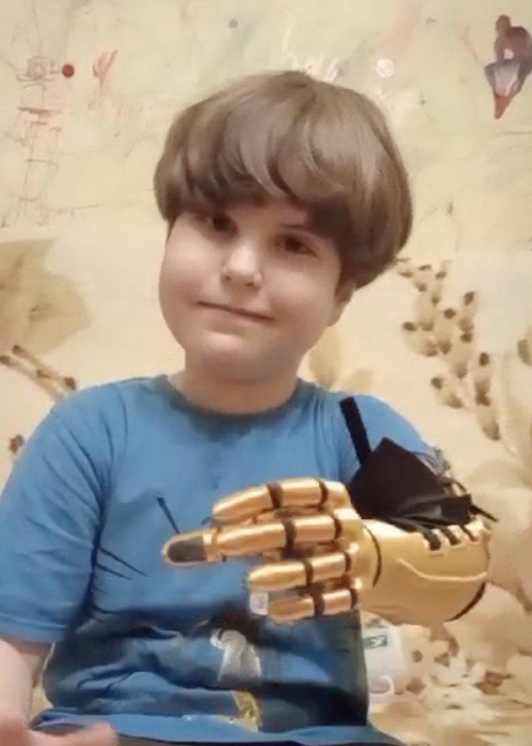 A. smiling with his gold Kinetic Arm. Romania