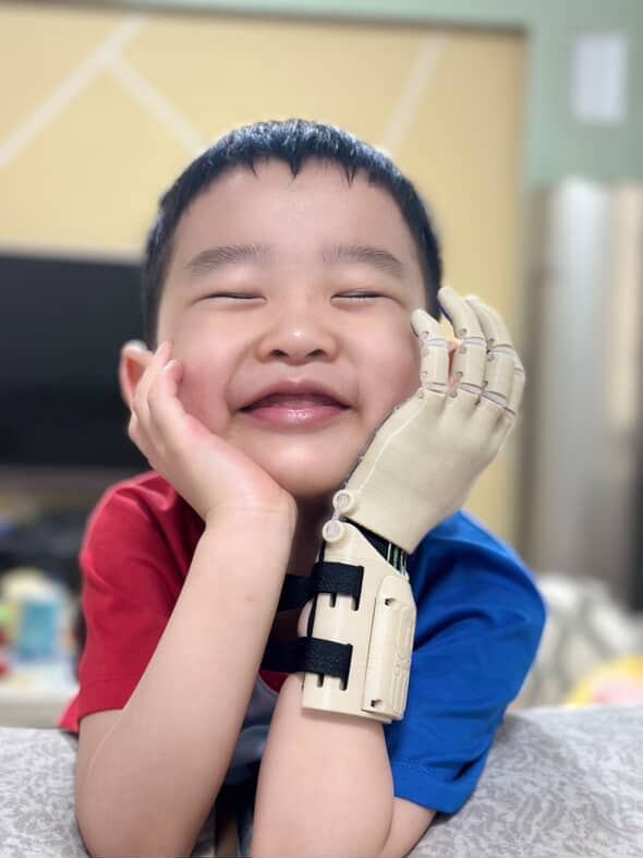 W. smiling with eyes closed, prosthetic hand resting on his cheek