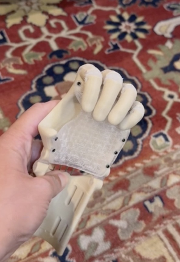Thumbless hand showing fist position