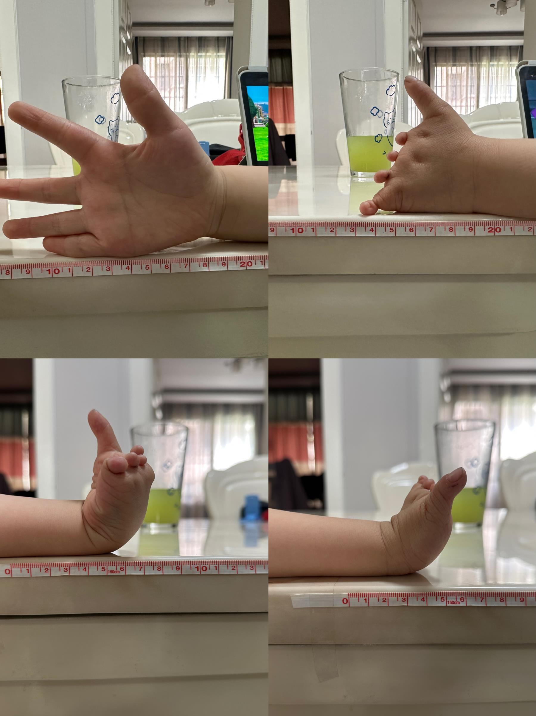 Four measurement photos of W.'s left hand, showing thumb and limb difference clearly