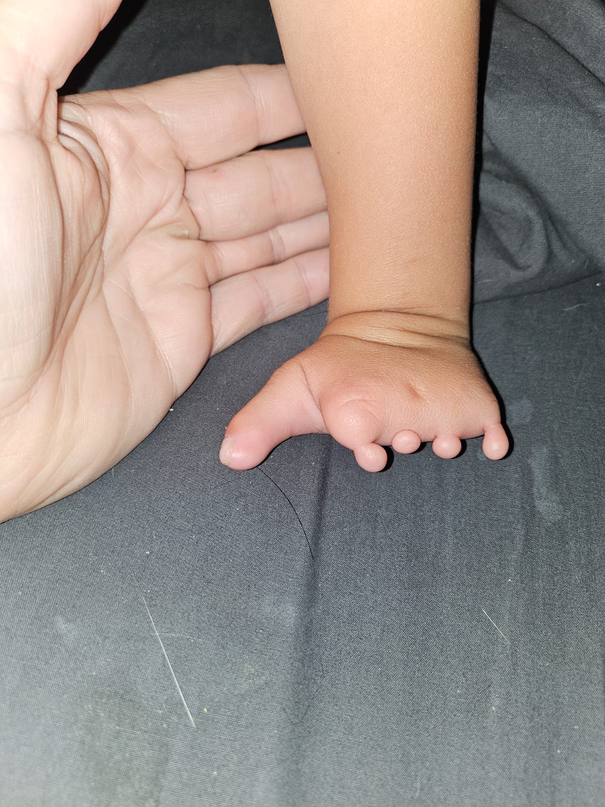 Noah's left hand with nubbins resting next to an adult hand for size reference, showing the full palm and the small rounded finger tips