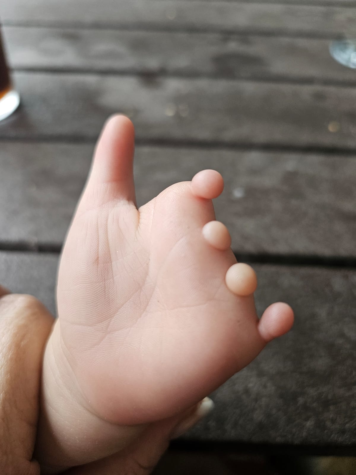 Noah's left hand palm-up on a wooden table, showing the nubbins where his four fingers would be, with his thumb fully developed