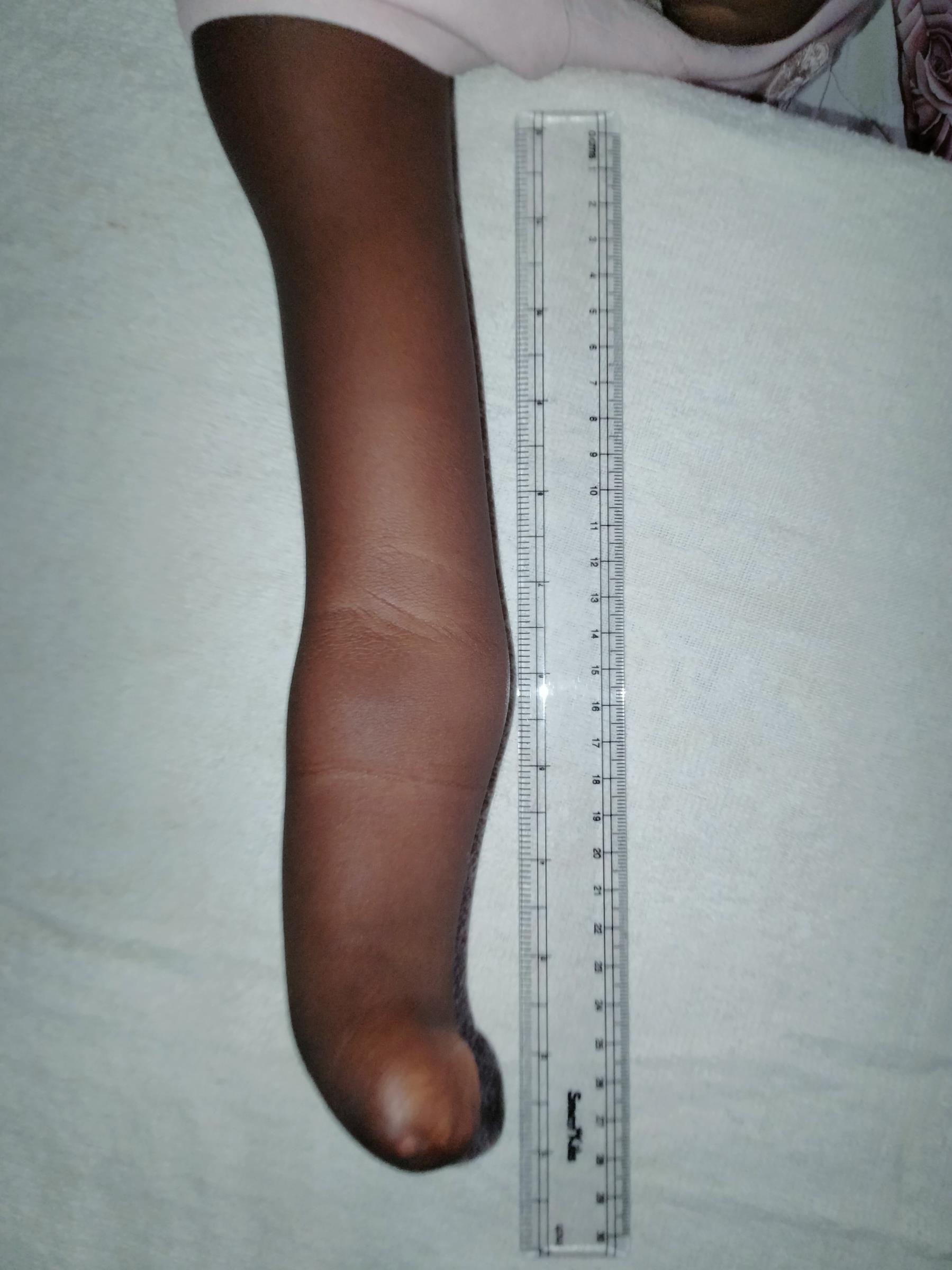 O.'s residual limb photographed alongside a ruler, clearly showing the curved tip