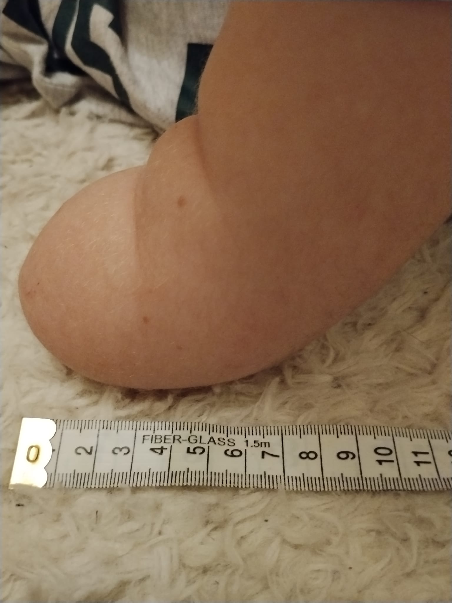 A.'s residual limb photographed from the side with a ruler, showing the rounded tip