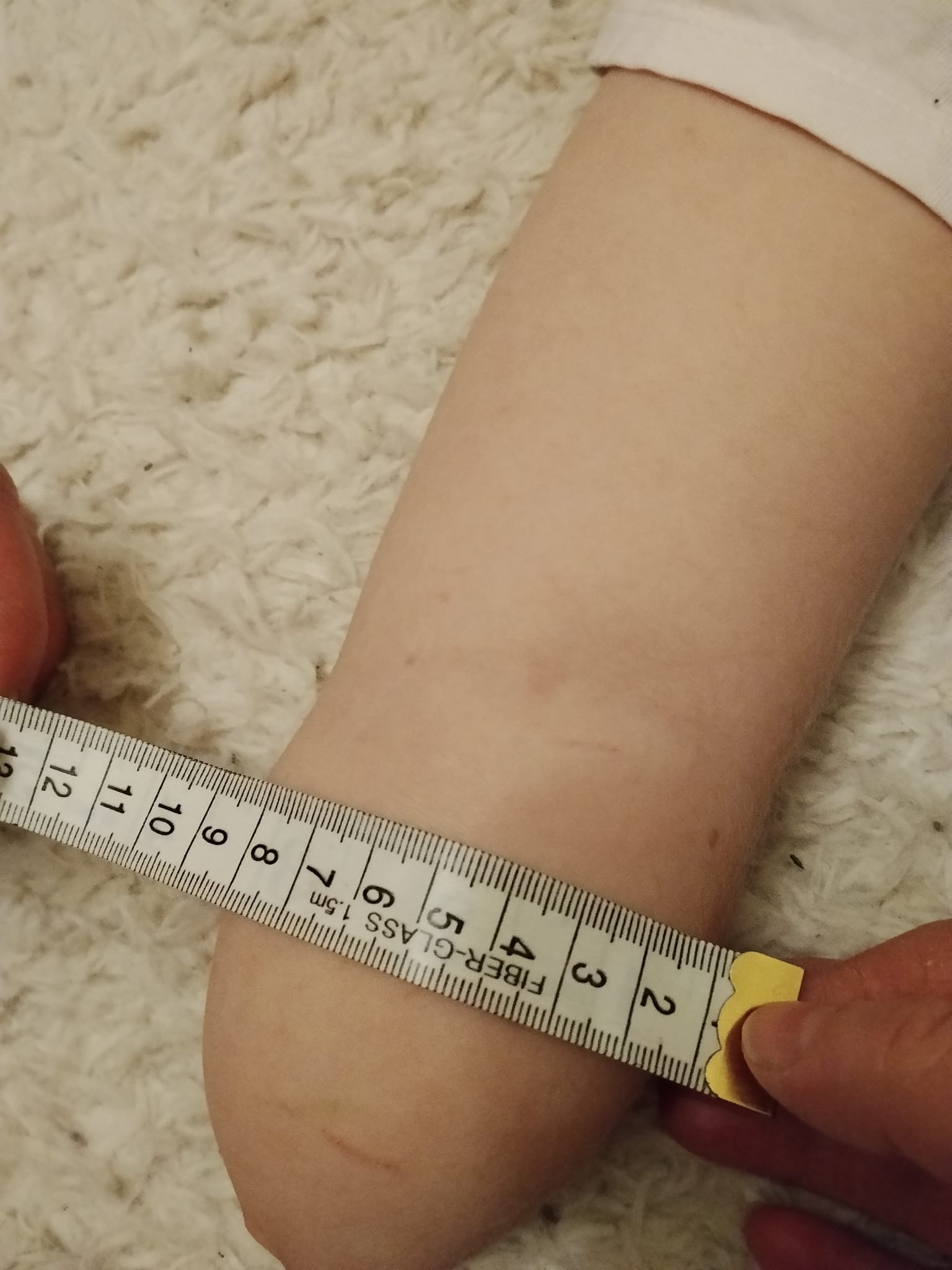 A.'s residual limb photographed to show width at the socket area